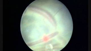 Sindrome de transfusión gemelo a gemelo  coagulacion laser de anastomosis placentarias [upl. by Amleht141]