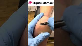 Cracked heel treatment by podiatrist in clinic ergonxcomau satisfying do you get cracked [upl. by Most118]