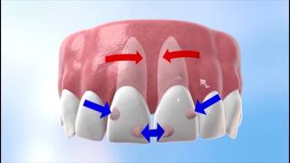 Discover how Invisalign works [upl. by Keenan574]