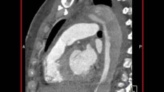 Cardiac Aortic dissection with compression of the true lumen by false lumen 3 of 4 [upl. by Acinorrev]