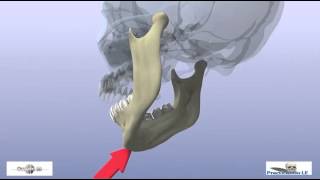 fractures of the mandibular condyle [upl. by Elatnahs]