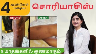 4 வயது சொரியாசிஸ் 9 மாதங்களில் குணமாகும்  Best Psoriasis Treatment  Psoriasis Recovery [upl. by Eanad]