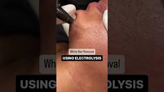 Electrolysis Hair Removal [upl. by Fleda]