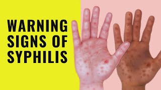 5 Symptoms of Syphilis  Early Signs and symptoms of syphilis  Syphilis [upl. by Cynthy]