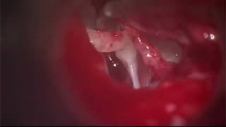 right stapedotomy using drill and vein graft  Dr Ashim Desai [upl. by Dominga910]