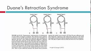 Duanes Retraction Syndrome Aetiology [upl. by Meave]