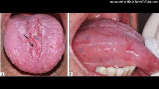 Geographic and fissured tongue showed a strong correlation with psoriasis [upl. by Ailecnarf]