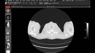 STR Cardiothoracic Case Webinar 192020 [upl. by Eanwahs]