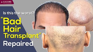 Corrective Hair Transplant scenario explained by Dr Pradeep Sethi [upl. by Ayr410]