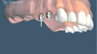 Implants dentaires et bridge sur implants pour remplacer plusieurs dents [upl. by Janik710]