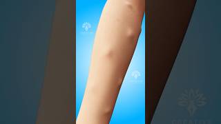 Why Do Lipomas Form Under Your Skin shorts viralvideo lipomas  Creativelearning3d [upl. by Welton677]