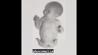 Phocomelia  A limb abnormality and a type of Meromelia [upl. by Mik]