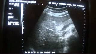 Lig Teres Ligamentum Venosum Median Lobar Fissure [upl. by Cir]