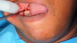 grossly decayed teeth 48 extraction by DrC Murugavel [upl. by Cecilio]