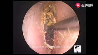 Contrast before and after treatment for fungal otitis externa 12 minutes [upl. by Nylsej]