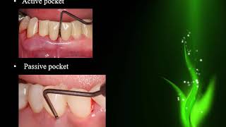 Periodontal Pocket [upl. by Niatsirk326]