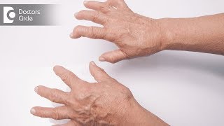 Signs and symptoms of Rheumatoid Arthritis  Dr Prashanth Jain [upl. by Ahsimak]