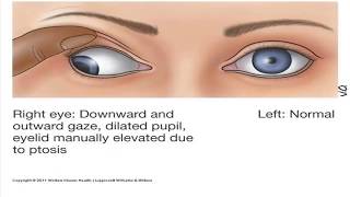 How to remember Cranial Nerves part 4 Abducens CNVI and Oculomotor nerve CNIII [upl. by Dyann]