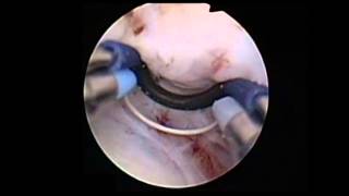 TUEB  Transurethral Enucleation [upl. by Niamor]