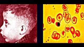 Thalassemia  Medical PowerPoint Presentation [upl. by Oirasan]