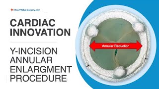 Cardiac Innovation YIncision Annular Enlargement Procedure with Dr Bo Yang [upl. by Adnohsek337]