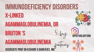 Immunodeficiency disorder  XLinked Hypogammaglobulinemia XLA or BRUTON’S Hypogammaglobulinemia [upl. by Ibocaj]