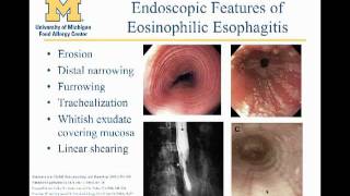 Eosinophilic Esophagitis Matthew Greenhawt MD [upl. by Mitran874]