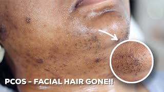 HOW TO WAX YOUR CHIN HAIR AT HOME  DIY Sugar Wax Hair Removal Hack [upl. by Ailen843]