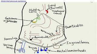 Do you have abdominal pressure syndrome rerun [upl. by Refinaj]