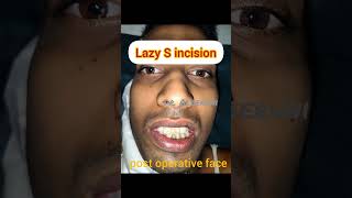 Lazy S incision for Superficial Parotidectomy [upl. by Shu994]