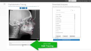 CephX  Uploading New Cephalometric Xray for Tracing amp Analysis [upl. by Vod]