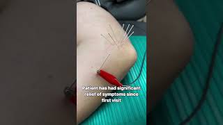 Dry Needling Treatment for UCL Sprain [upl. by Aihselef]