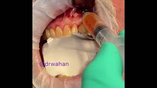 Aspirating a Radicular Cyst [upl. by Aerdnna]