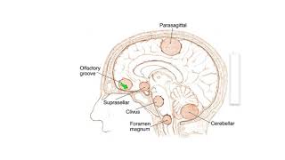 Meningiomas Signs Symptoms and Advanced Treatment Options [upl. by Idnak739]