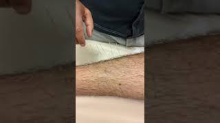 Local Treatment for Shin Splints [upl. by Yhtuv]