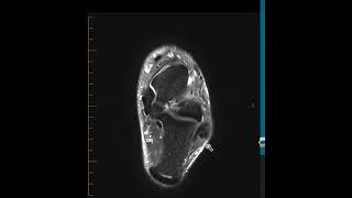 Calcaneal lipoma [upl. by Maegan]