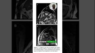 Identificación de Fibrosis Miocárdica en Resonancia Magnética [upl. by Oleg675]