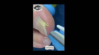 Toenail Reshaping How to Fix a Deformed Big Toenail [upl. by Wiersma648]