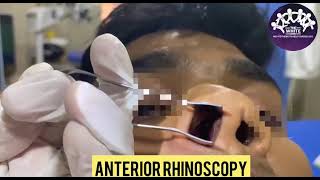 ANTERIOR RHINOSCOPY for DNS [upl. by Ennair17]