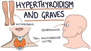 Understanding Hyperthyroidism and Graves Disease [upl. by Noscire]