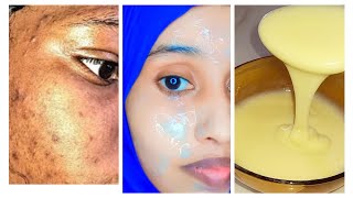 wajiga madmadowga iyo haaraha 7dayz isaga saar wajigagana ku cadee dark spot on face removal [upl. by Dunson]