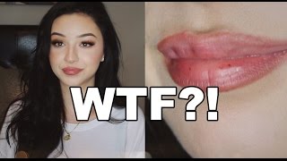 The TRUTH About Lip Injections [upl. by Enilrem]