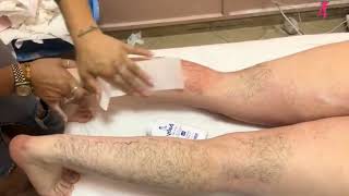 Today I Have A 24 Year Old Girl To Get Her Leg Hair Removed  Girl Hair Removal Waxing Leg [upl. by Amlas]