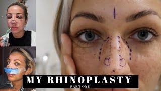 MY RHINOPLASTY PART ONE  MY REASONS WHY DAY OF PROCEDURE amp INITIAL THOUGHTS  Asher MaryLou [upl. by Leesen]