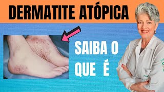 DERMATITE ATÓPICA Saiba O Que é E Como Tratar [upl. by Ahsenar]