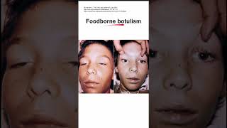 Foodborne botulism [upl. by Ahsimek]