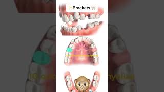 Second premolars extraction orthodontie kieferorthopädie orthodontics ortodonzia ortodoncia [upl. by Oliver]