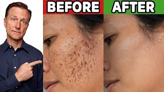 How to Get Rid of Hyperpigmentation Aging or Dark Spots [upl. by Pembrook]