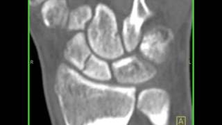 Wrist Anatomy Nonunion of a scaphoid fracture 3 of 3 [upl. by Ecilef]