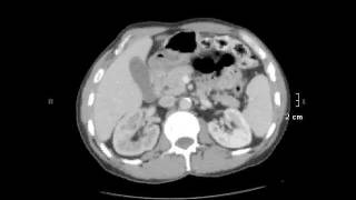 bladder ca 2 [upl. by Chantal]